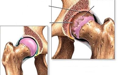 Diagnostic de l'arthrose de la hanche