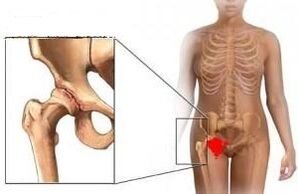 Les raisons du développement de l'arthrose de l'articulation de la hanche