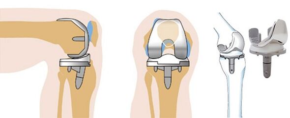 Fonctionnement endoprosthétique de l'articulation du genou pour l'arthrose