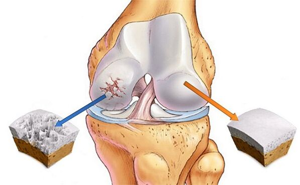 Norme et déviation à l'arthrose de l'articulation du genou