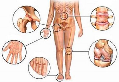 Arthrite et arthrose de différentes articulations