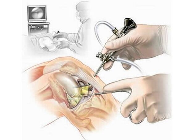 Arthroscopie de l'articulation du genou
