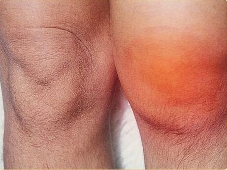 Inflammation de l'articulation du genou affectée par l'arthrite