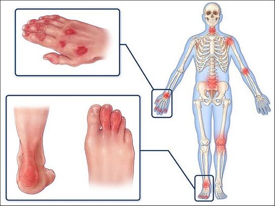 Réduction de la peau et gonflement des articulations avec arthrite