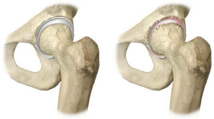 articulation de la hanche saine et nécrose de la tête comme cause de douleur