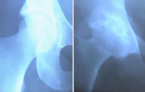 Image d'arthrose de l'articulation du genou