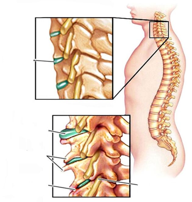 Ostéochondrose et une colonne cervicale saine