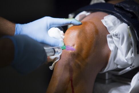 Injections dans l'articulation du genou pour l'arthrose